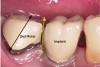 Fig 5. Spontaneous passive eruption into occlusion once the tube attachment is removed.